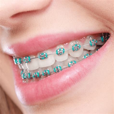 Transform Your Smile Instantly with Magic Teeth Brace Veneers